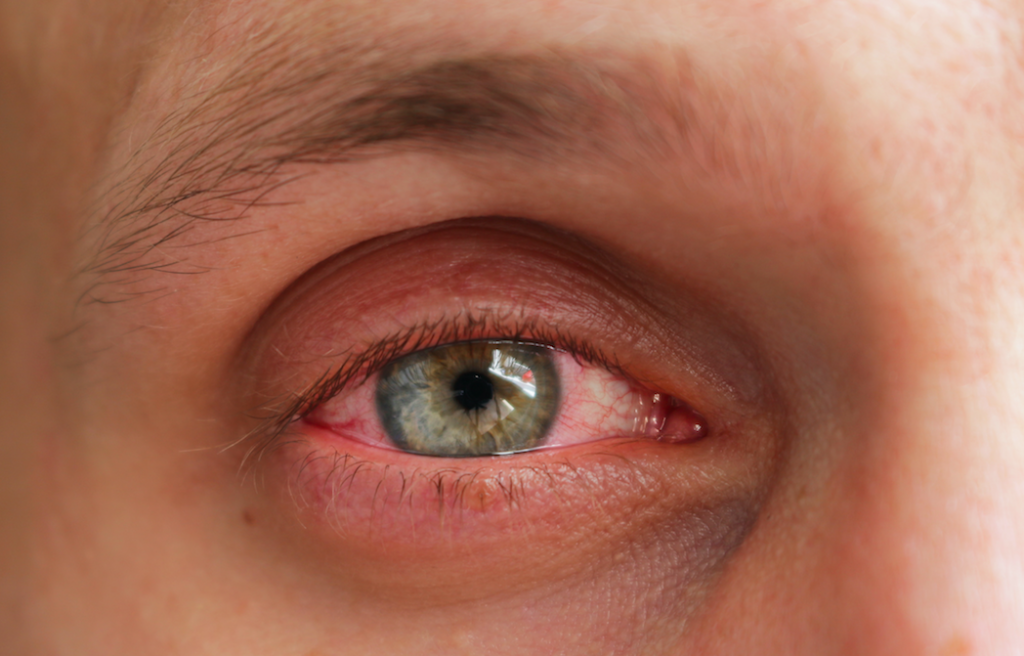 What Causes Eye Allergies And How Are They Treated 